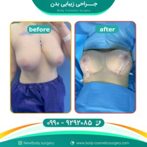 لیفت سینه