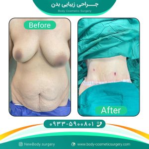 ابدومینوپلاستی