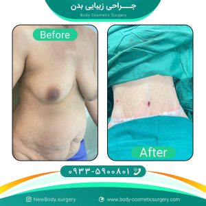 ابدومینوپلاستی