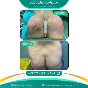 تزریق چربی به باسن