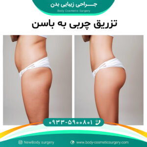 تزریق چربی به باسن