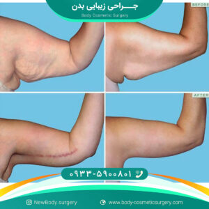 لیپوماتیک بازو