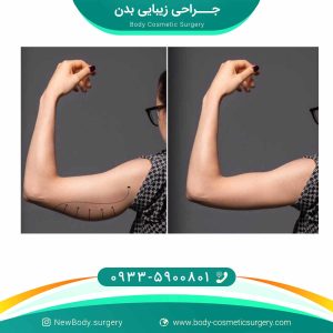 لیپوماتیک بازو