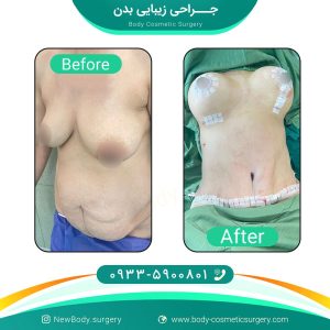 شیردهی بعد از پروتز سینه