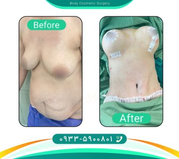 جراحی زیبایی بدن