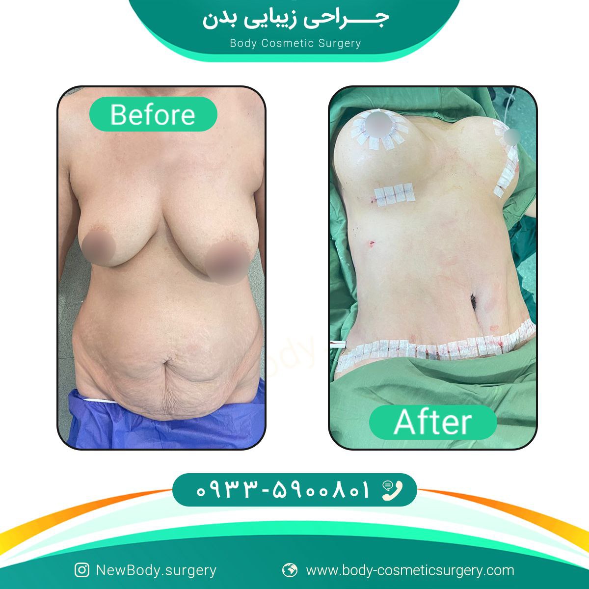 جراحی زیبایی بدن