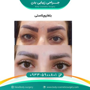 بلفاروپلاستی