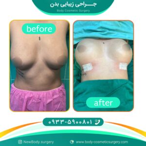 شیردهی بعد از پروتز سینه