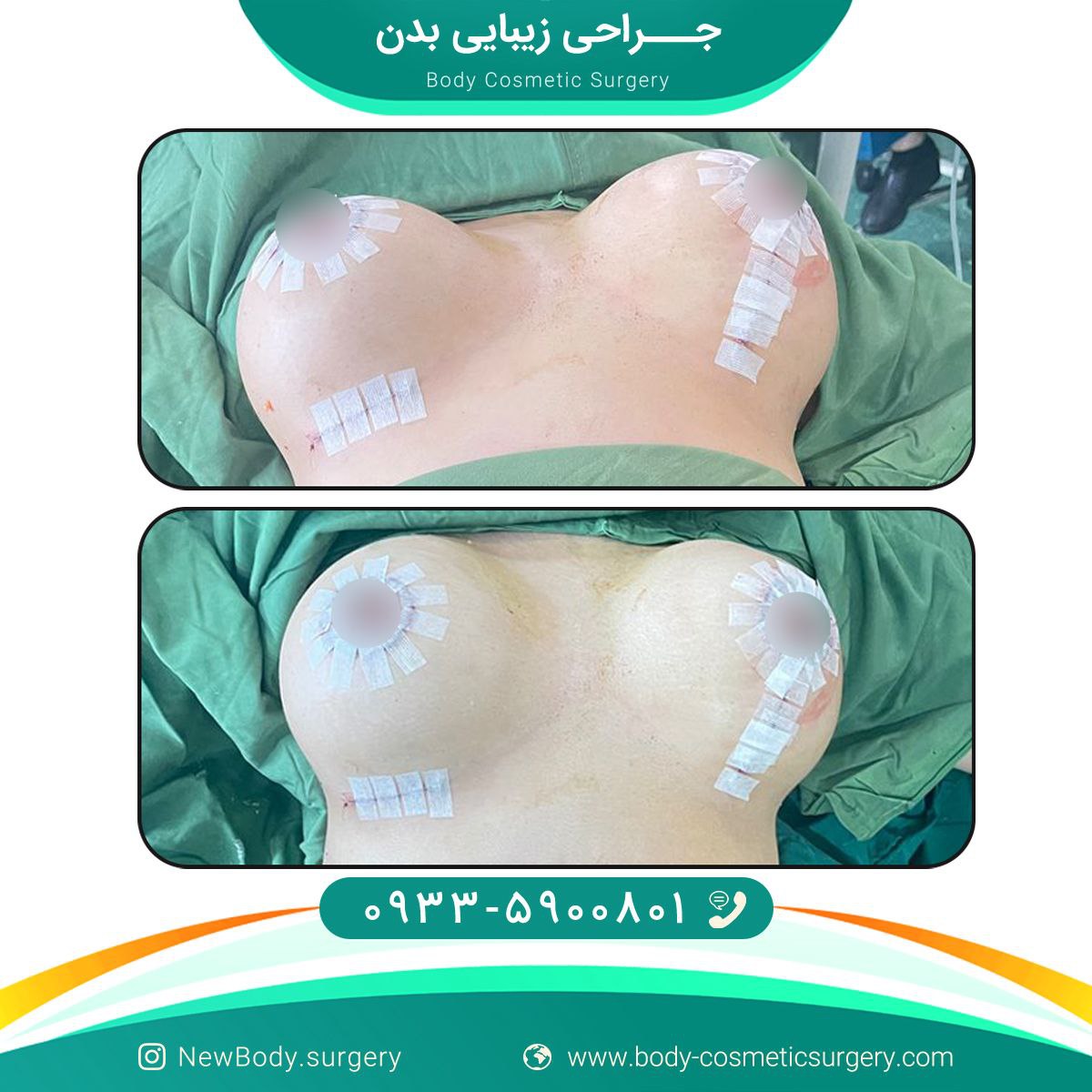 جراحی زیبایی بدن