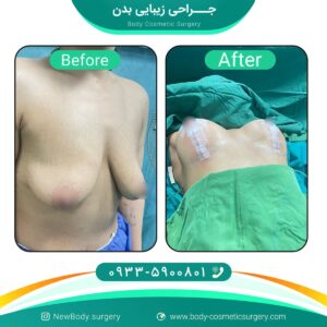 مراقبت بعد از پروتز سینه