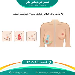 چه سنی برای جراحی لیفت پستان مناسب است؟
