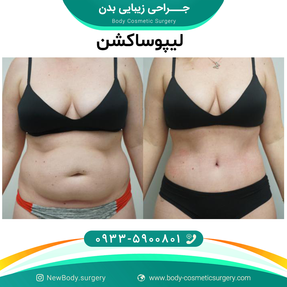 جراحی زیبایی بدن