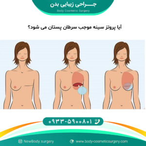 آیا پروتز سینه موجب سرطان پستان می شود؟