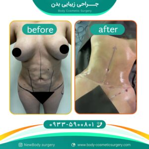 ابدومینوپلاستی در تهران