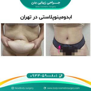 ابدومینوپلاستی در تهران