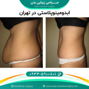 ابدومینوپلاستی در تهران