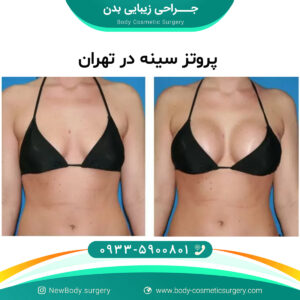 پروتز سینه در تهران