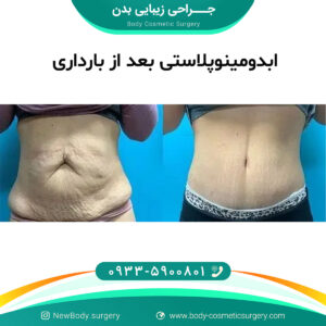 ابدومینوپلاستی بعد از بارداری