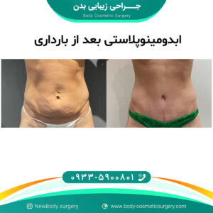 ابدومینوپلاستی بعد از بارداری