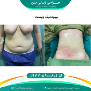 لیپوماتیک در تهران