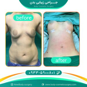 قیمت لیپوماتیک