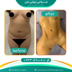 قیمت لیپوماتیک