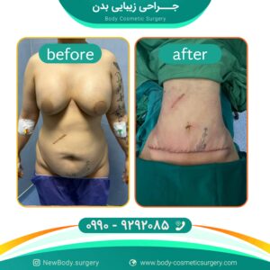 تفاوت لیپوماتیک با پیکر تراشی