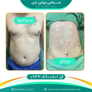 تفاوت لیپوماتیک با پیکر تراشی