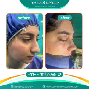 جراحی بینی گوشتی در تهران