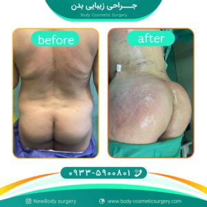 فرم دهی باسن با تزریق چربی خود