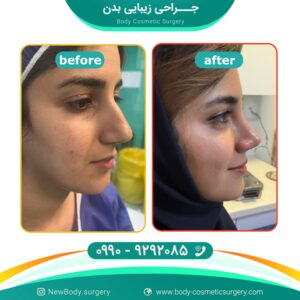 جراحی بینی + چانه متعادل سازی چهره