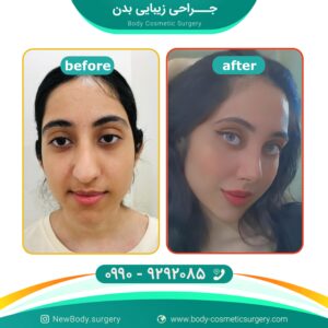 عمل همزمان بینی و چانه