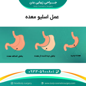 اسلیو معده چیست؟