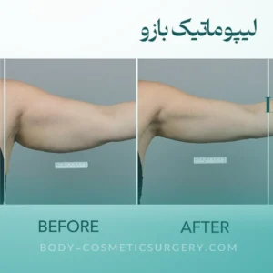 همه چیز در مورد لیپوماتیک شکم