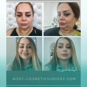 تزریق چربی به صورت یا فیلر؟