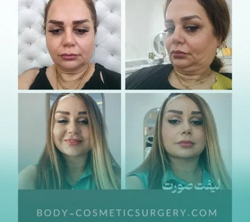 لیفت صورت 360x320